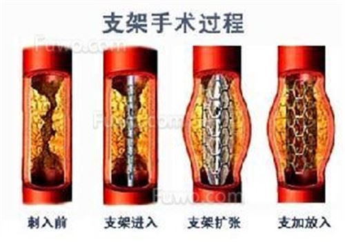 从心脏支架直降95%看中国医改